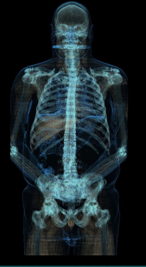 PET CT image